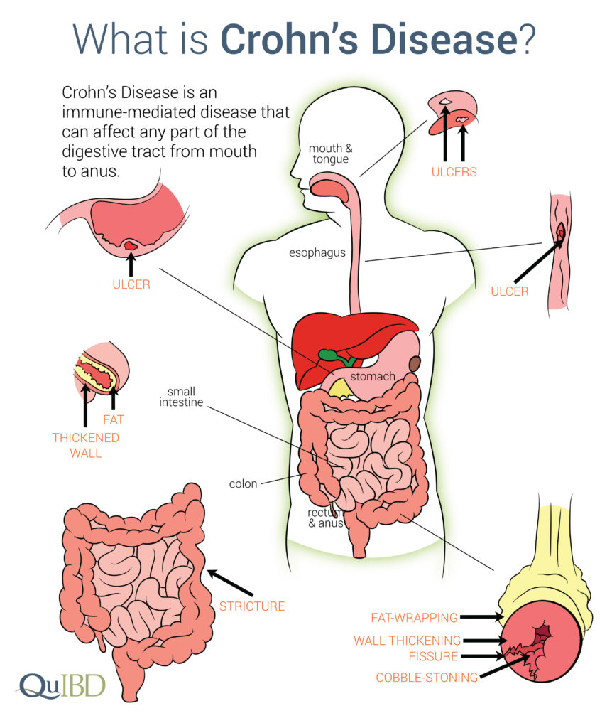 crohn’s disease, immune-mediated disease that affects digestive tract