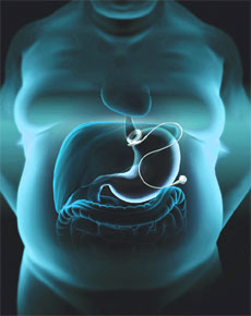 Bariatric Surgery