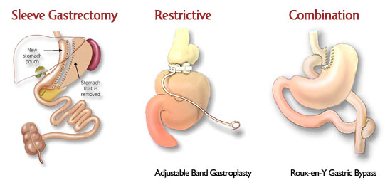 Bariatric Surgery, Sleeve Gastrectomy, Adjustable Band Gastroplasty, Gastric Bypass