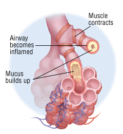 Chronic Obstructive Pulmonary Disease, COPD