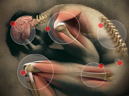 Fibromyalgia, the Central Sensitization Syndrome, is No Joke