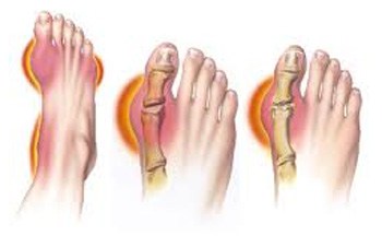 Uric Acid, gout