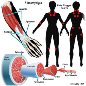 supporting a friend with Fibromyalgia