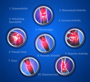 types of arthritis,osteoarthritis,rheumatoid,fibromyalgia,psoriatic,reactive