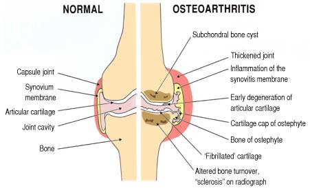 osteoarthritis, Degenerative Joint Disease
