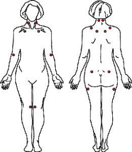 Living with Central Sensitization Syndrome, Fibromyalgia tender points