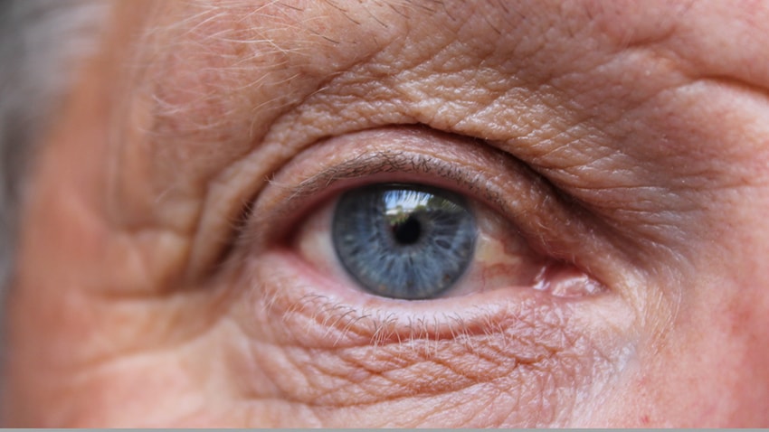 Macular Degeneration: An Age-Related Eye Disease and How to Help Your Eyes