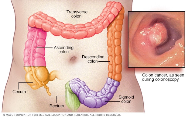 Learning About Colorectal Cancer