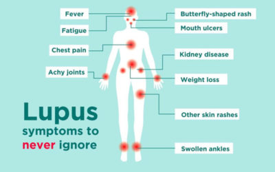 Learning About Lupus