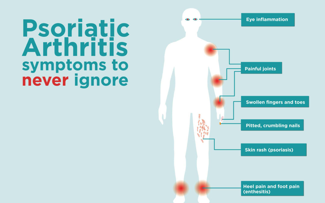 Psoriatic Arthritis Symptoms