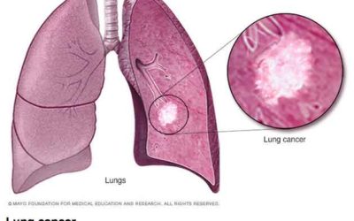 Learning About Lung Cancer