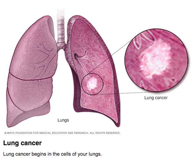 Lung Cancer