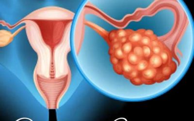 Learning About Ovarian Cancer