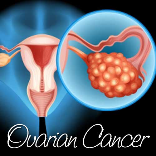 Learning About Ovarian Cancer