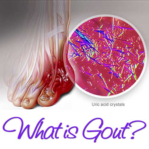 Learning About Gout