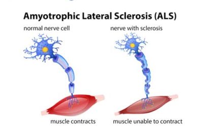 Learning About Amyotrophic Lateral Sclerosis (ALS) aka Lou Gehrig’s Disease