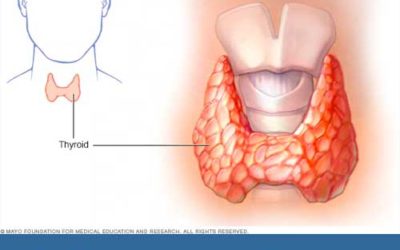 Learning About Hashimoto’s Disease