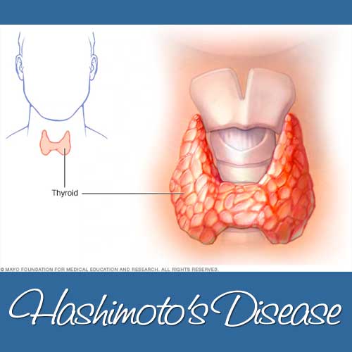 Learning About Hashimoto’s Disease