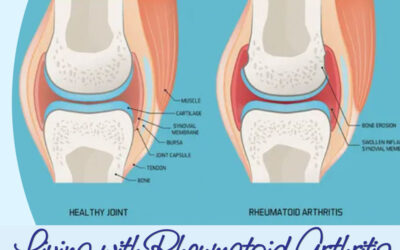 Living With Rheumatoid Arthritis